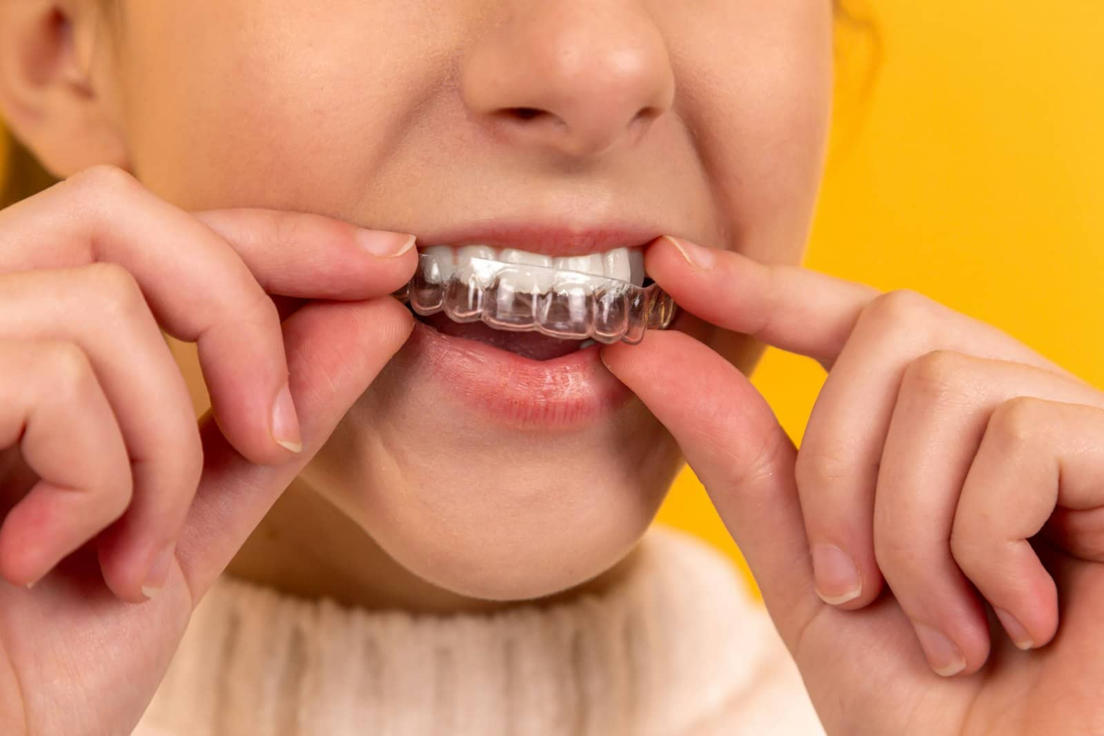 Person placing a clear Invisalign-style aligner onto their teeth
